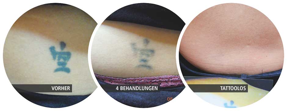 Tattooentfernung in Magdeburg | tattoolos